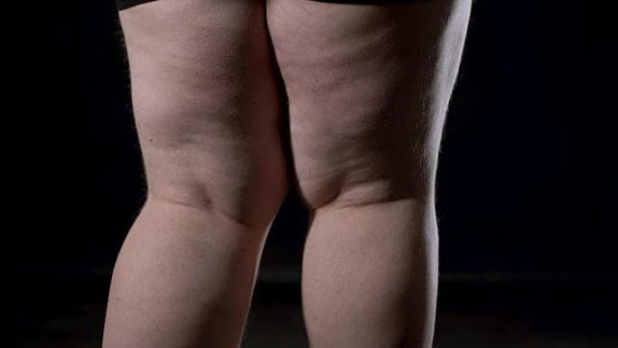 男性腿部脂肪团有妊娠纹，荷尔蒙失调，皮肤护理，饮食