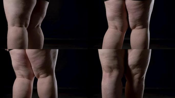 男性腿部脂肪团有妊娠纹，荷尔蒙失调，皮肤护理，饮食
