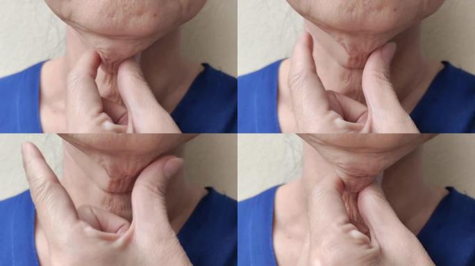 松弛的脂肪挂在脖子下的皮肤，皱纹和松弛的皮肤在下巴下。