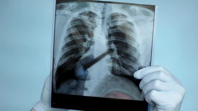 特写，医生在手术室里用手拍了肺部x光。医生在医院仔细分析了一个人肺部的x光片。超声检查肺损伤，肺炎。