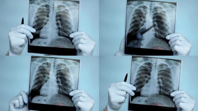 特写，医生在手术室里用手拍了肺部x光。医生在医院仔细分析了一个人肺部的x光片。超声检查肺损伤，肺炎。