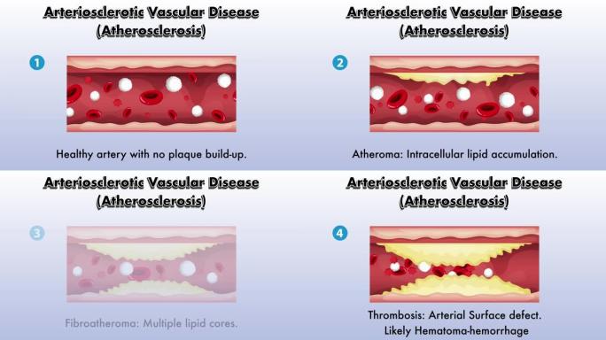 动脉硬化血管疾病 (动脉粥样硬化) 动画