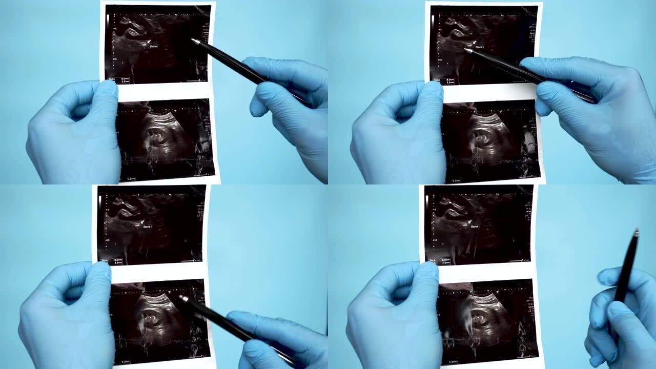 在医生的手中，通过超声波检查人类肾结石的x射线，医务人员分析人类肾脏8毫米中结石或结石的超声波。在蓝