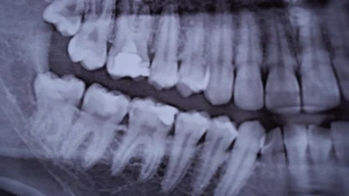 所有人类牙齿颌部的x射线图像特写