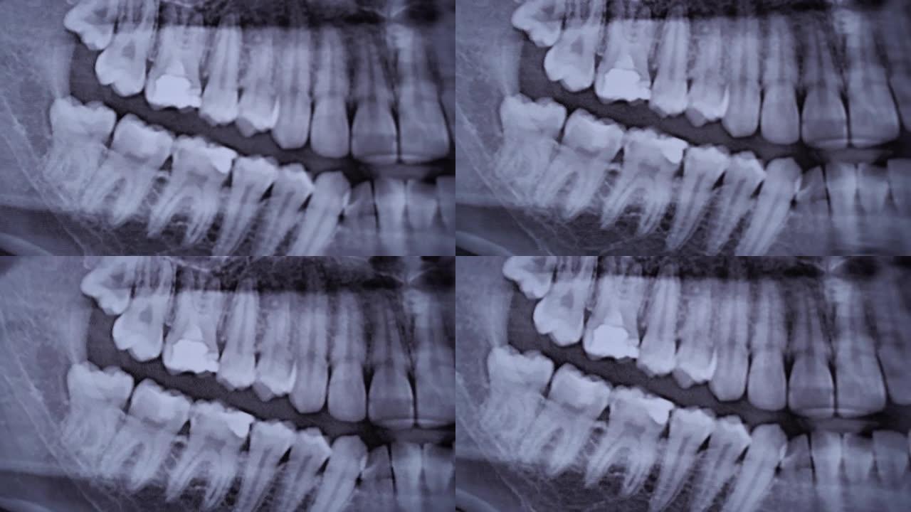 所有人类牙齿颌部的x射线图像特写