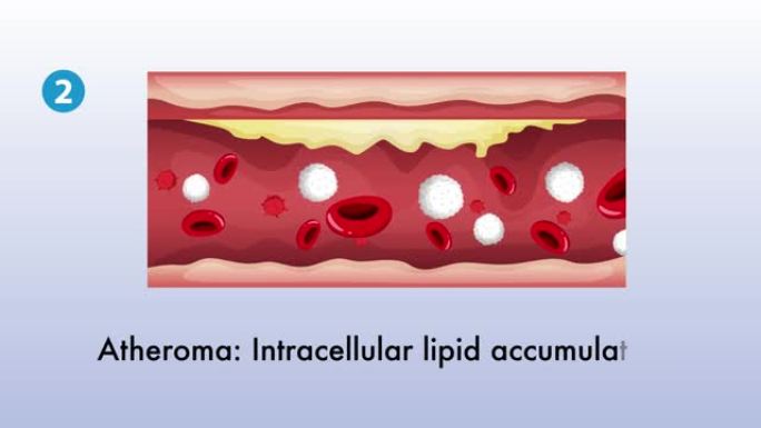 动脉硬化血管疾病 (动脉粥样硬化) 动画