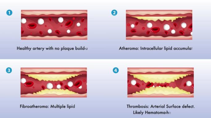动脉硬化血管疾病 (动脉粥样硬化) 动画