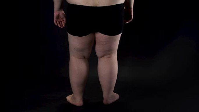 肥胖的男性腿在黑暗的背景，健康问题，不安全感，疾病