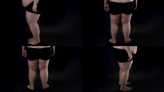 肥胖的男性腿在黑暗的背景，健康问题，不安全感，疾病