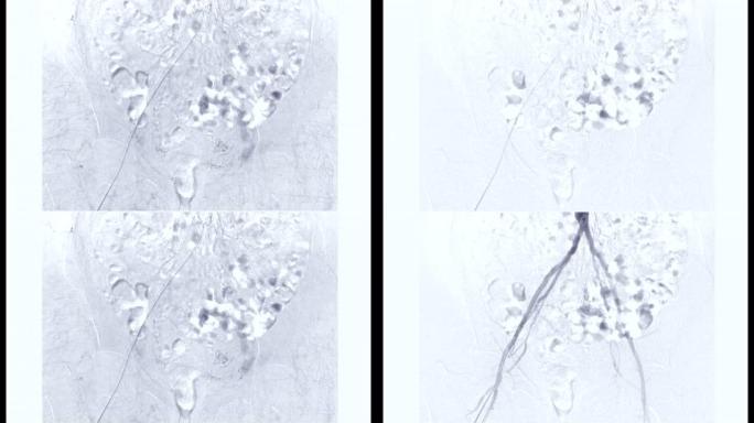 股动脉血管造影或血管造影。