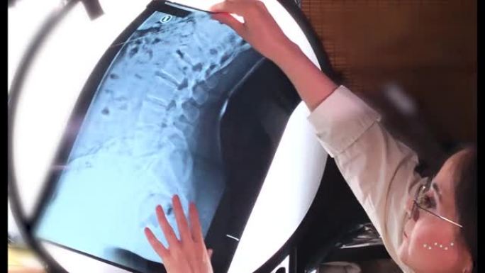 视频骨科医生分析脊柱侧视x线片的医学报告先天性脊柱侧凸在患者俯视