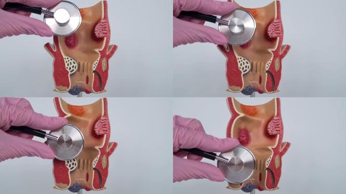 肛门解剖和肠道治疗医生用听诊器
