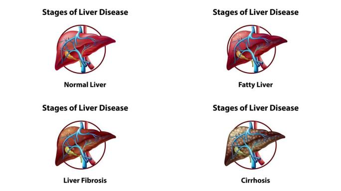 肝脏疾病阶段的2D动画。