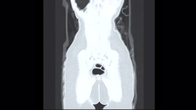 CT全腹部对比剂冠状位。