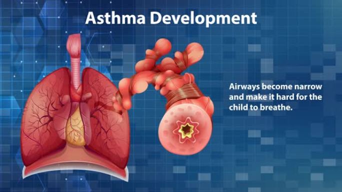 哮喘发展的动画解释