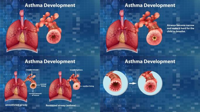 哮喘发展的动画解释