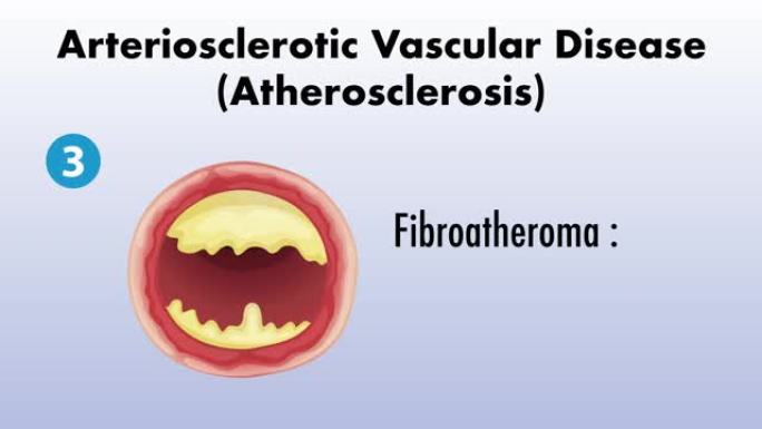 动脉硬化血管疾病 (动脉粥样硬化) 动画