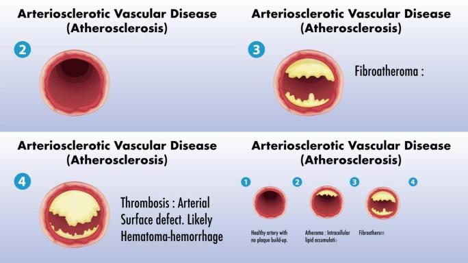 动脉硬化血管疾病 (动脉粥样硬化) 动画