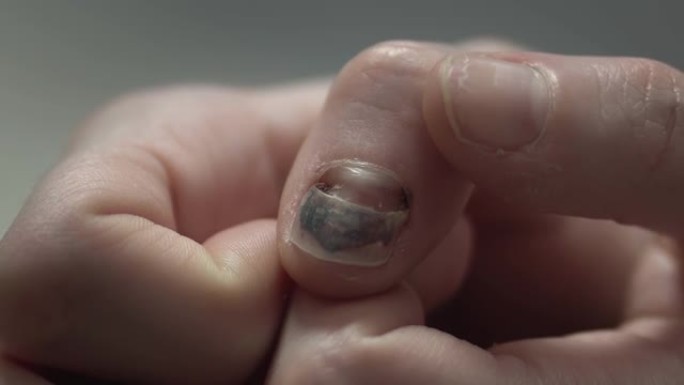女性在感染性疾病后重新长出新指甲，受伤。指甲在手指和瘀伤上脱落