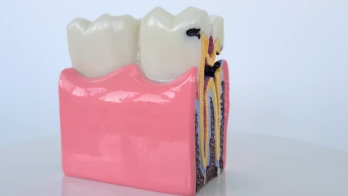 龋齿和牙颌模型