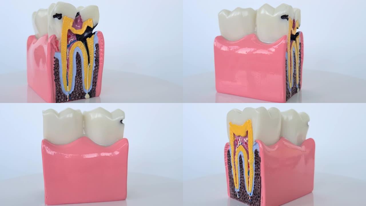 龋齿和牙颌模型