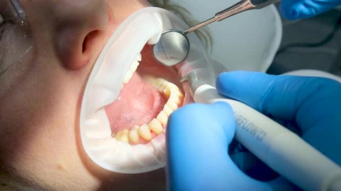 牙科用女性刷牙清洁去除牙菌斑结石唾液喷射器使用口腔镜最新技术喷砂镜护目镜水滴溢出侧面optragat