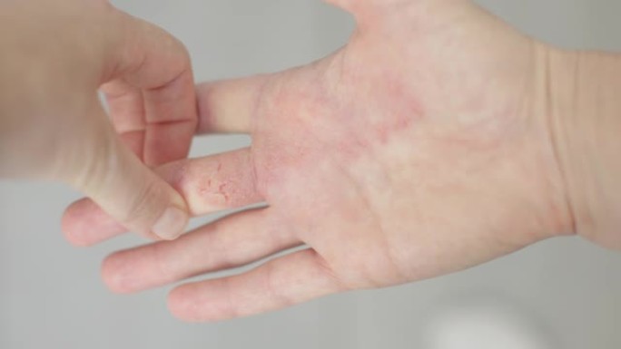 皮肤炎手掌上皮肤发痒抓痕女性手部干性湿疹