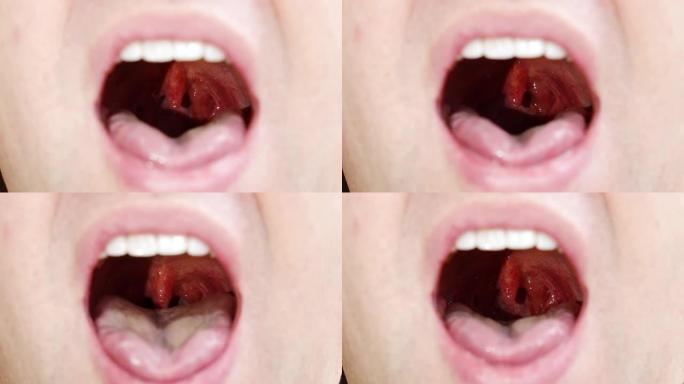 一个男人的嘴特写。腭悬雍垂和咽喉粘膜。