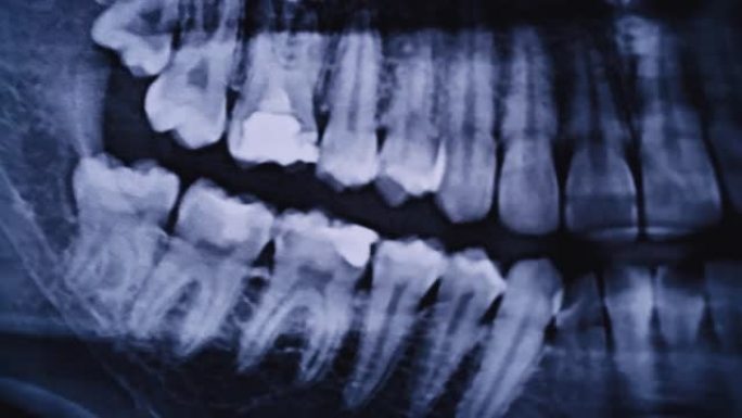 所有人类牙齿的颌骨的x射线图像特写