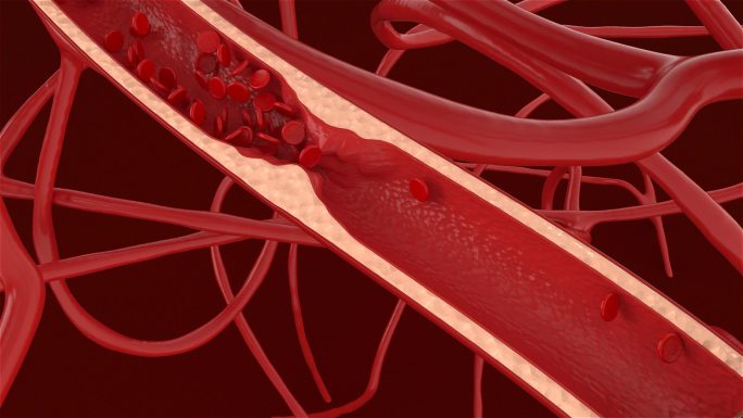 血管支架