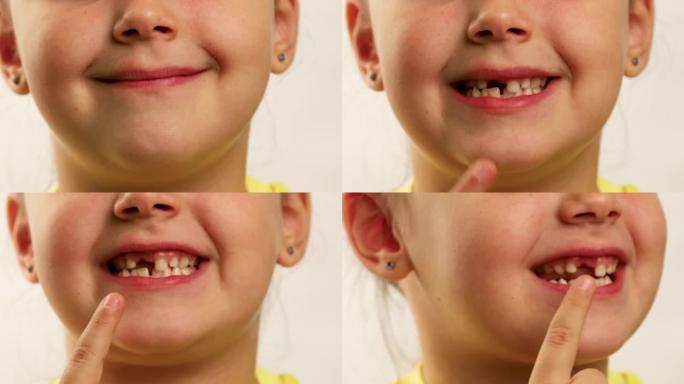 有趣的小女孩面带微笑，用手指指着嘴里的缝隙，从掉牙和转头特写，白色背景。快乐无牙孩子的脸。健康牙齿和