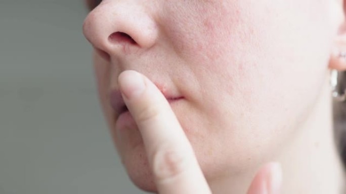 嘴唇上的单纯疱疹: 女性手指上的疱疹病毒疮。
