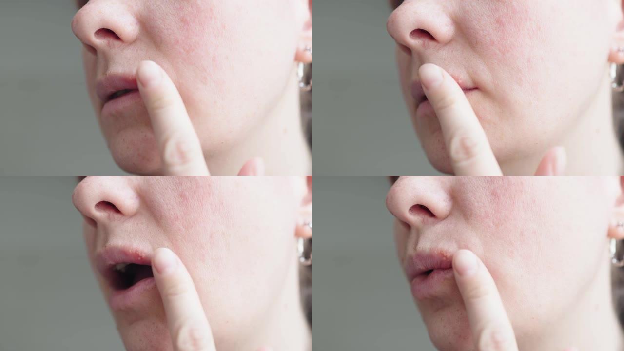 嘴唇上的单纯疱疹: 女性手指上的疱疹病毒疮。