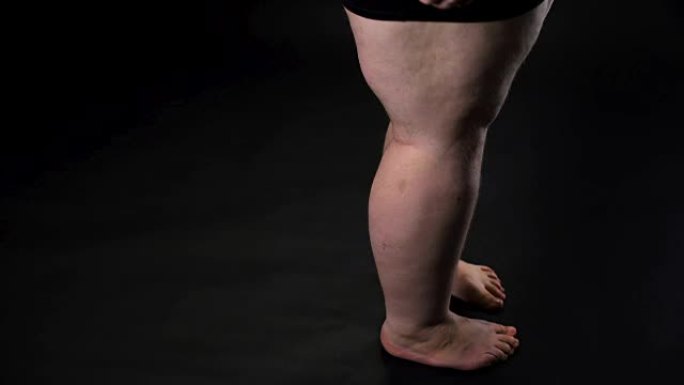 肥胖的男性腿部皮肤松弛和脂肪团，食物摄入过多保健