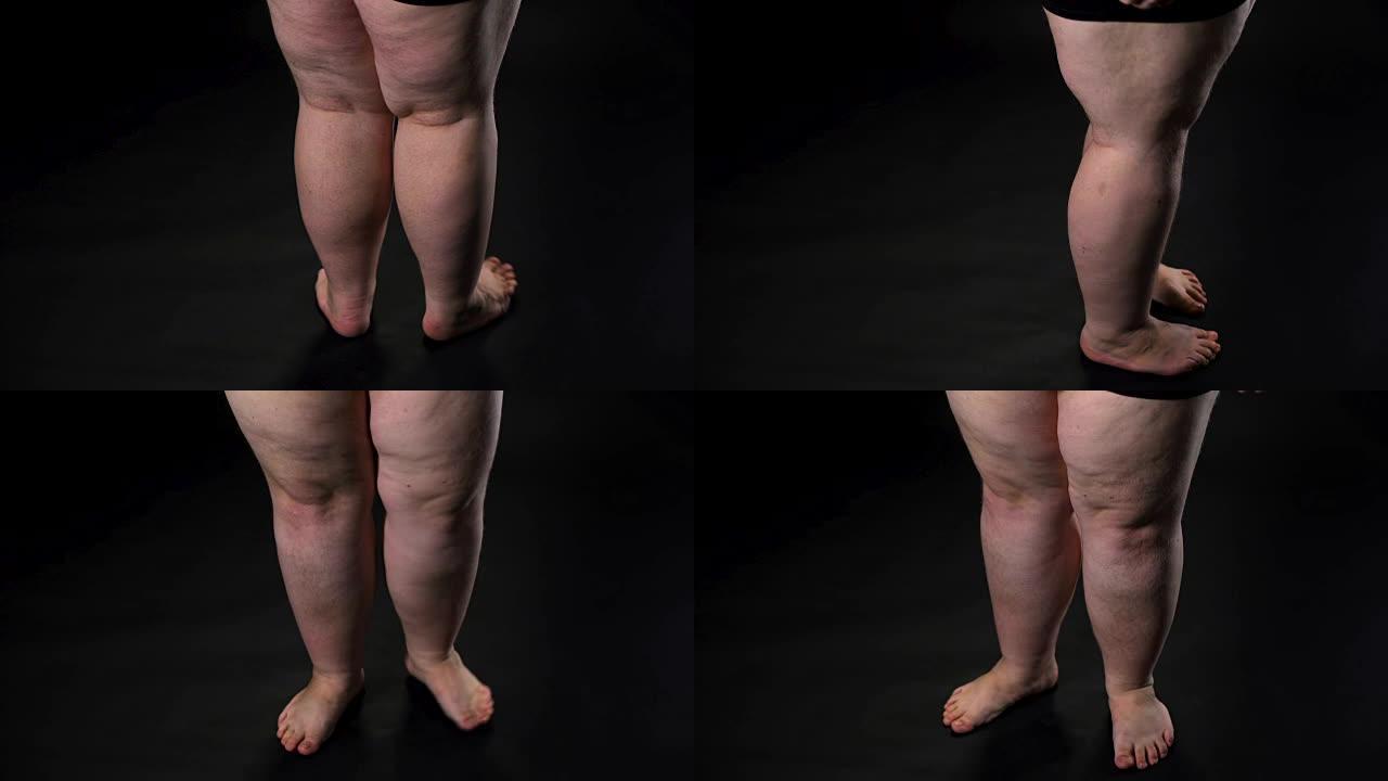 肥胖的男性腿部皮肤松弛和脂肪团，食物摄入过多保健
