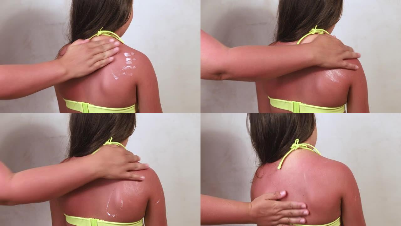 无法辨认的女人在小女孩背部烧红的皮肤上涂上特殊的光滑泛醇治疗霜。