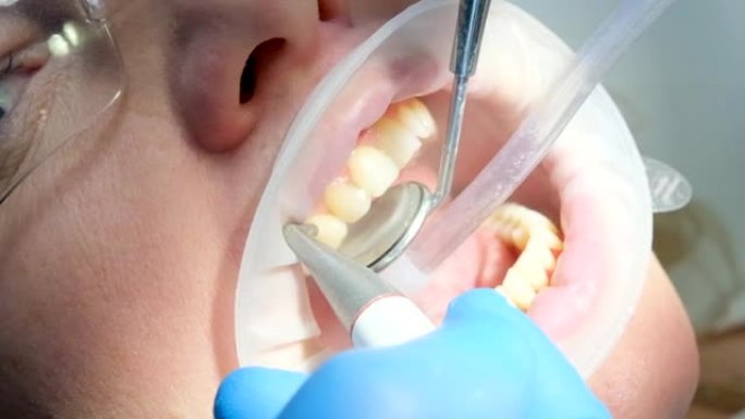 牙科用女性刷牙清洁去除牙菌斑结石唾液喷射器使用口腔镜最新技术喷砂镜护目镜水滴溢出侧面optragat