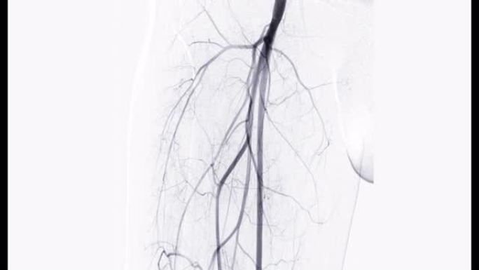 股动脉血管造影或血管造影。