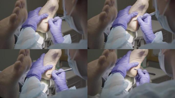 足病医生在客户的脚后跟上切开多余的皮肤的特写