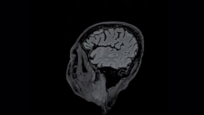MRI脑矢状面可以帮助医生寻找出血、肿胀、肿瘤、感染、炎症、损伤或中风疾病等疾病。