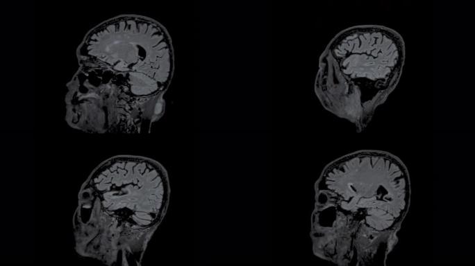 MRI脑矢状面可以帮助医生寻找出血、肿胀、肿瘤、感染、炎症、损伤或中风疾病等疾病。