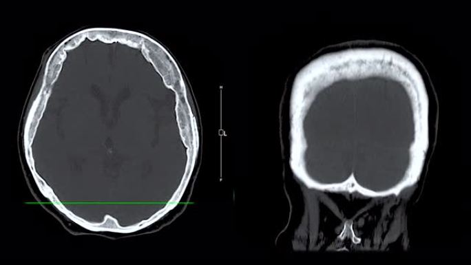 脑部ct扫描可诊断脑肿瘤，中风疾病和血管疾病。