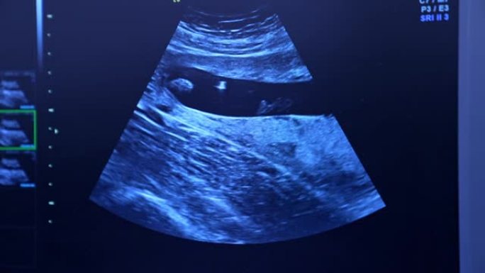 女性生殖器官的超声图像。体外授精前对患者的诊断。特写。