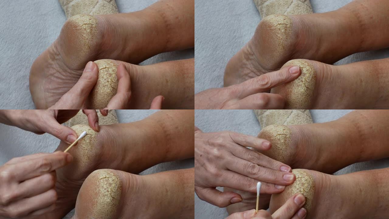 人类脚后跟有问题的皮肤干燥开裂。女性双手接触干燥粗糙的腿部皮肤的特写镜头。医生检查患者的脚后跟破裂的