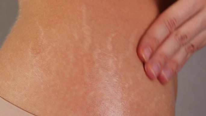 女人臀部上的妊娠纹。皮肤拉伸霜