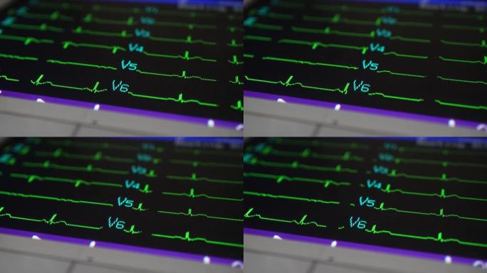 EKG屏幕显示特写展示声波