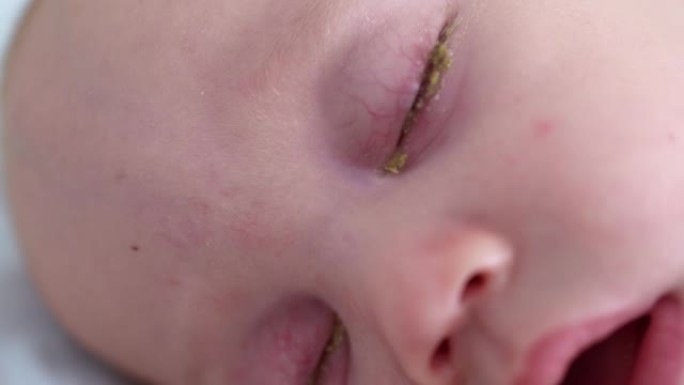 新生儿结膜炎熟睡的婴儿眼睛的特写镜头粉红色的眼睛特写镜头