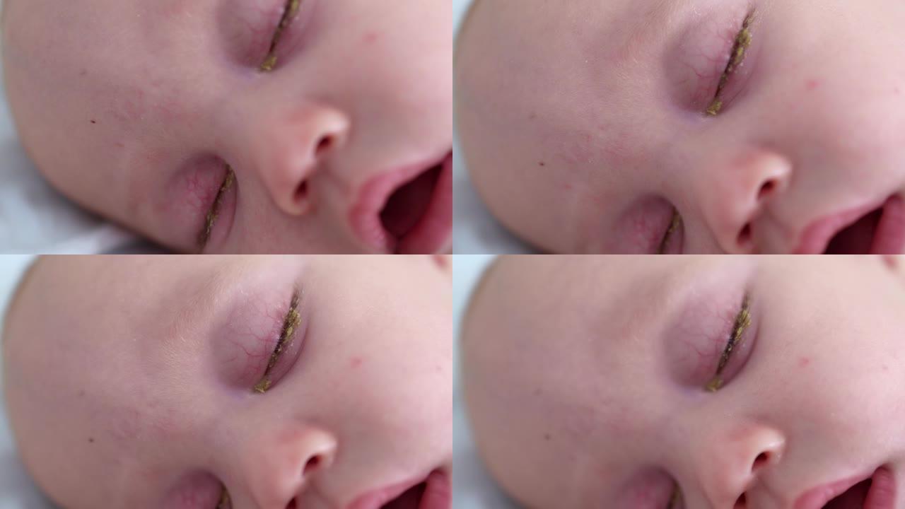 新生儿结膜炎熟睡的婴儿眼睛的特写镜头粉红色的眼睛特写镜头