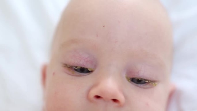婴儿的眼睛结膜炎粉红色的眼睛在新生儿特写视图