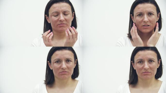 有皮肤问题的特写女性脸的4k视频。